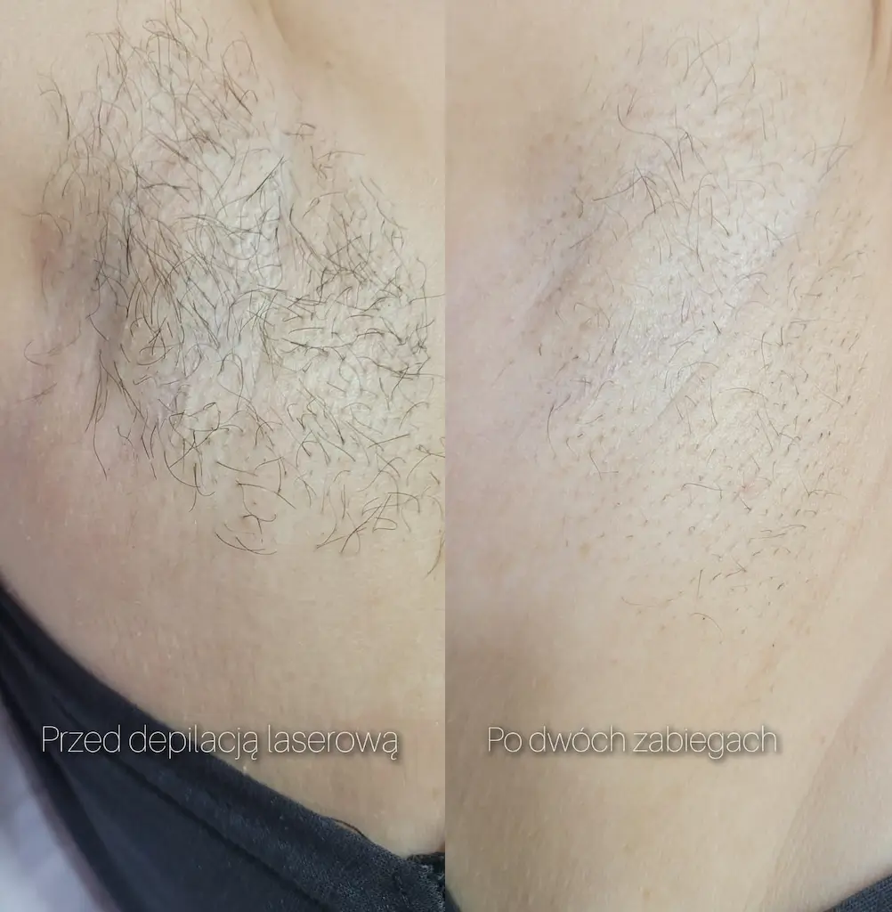 Okolica zabiegowa w trakcie terapii epilacją laserową.